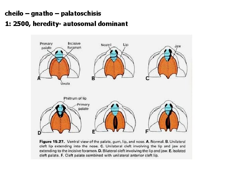 cheilo – gnatho – palatoschisis 1: 2500, heredity- autosomal dominant 