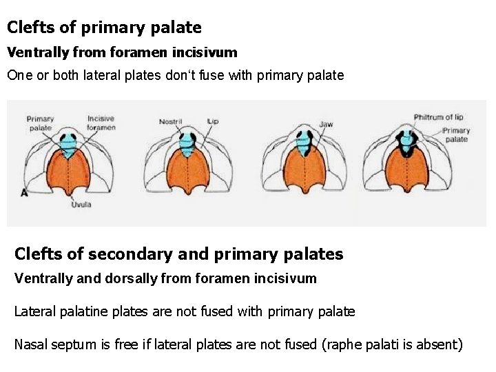 Clefts of primary palate Ventrally from foramen incisivum One or both lateral plates don‘t