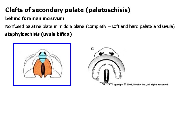 Clefts of secondary palate (palatoschisis) behind foramen incisivum Nonfused palatine plate in middle plane