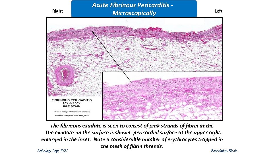 Right Acute Fibrinous Pericarditis Microscopically Left The fibrinous exudate is seen to consist of