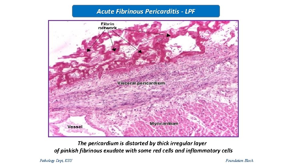 Acute Fibrinous Pericarditis - LPF The pericardium is distorted by thick irregular layer of