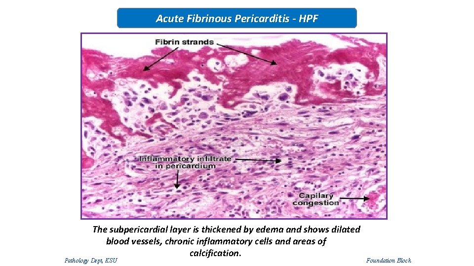 Acute Fibrinous Pericarditis - HPF The subpericardial layer is thickened by edema and shows