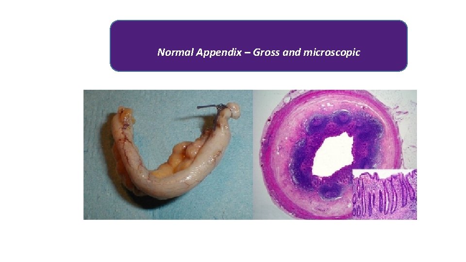 Normal Appendix – Gross and microscopic 