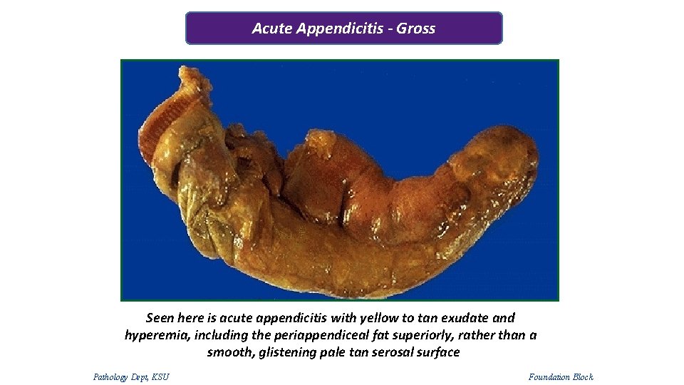 Acute Appendicitis - Gross Seen here is acute appendicitis with yellow to tan exudate