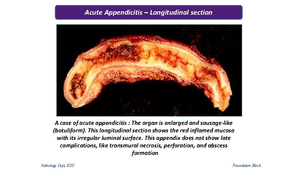 Acute Appendicitis – Longitudinal section A case of acute appendicitis : The organ is