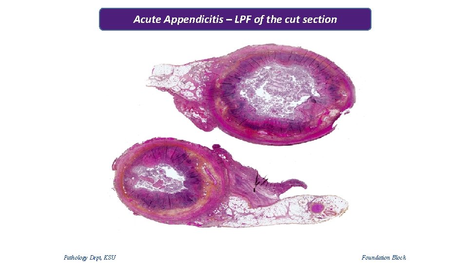 Acute Appendicitis – LPF of the cut section Pathology Dept, KSU Foundation Block 