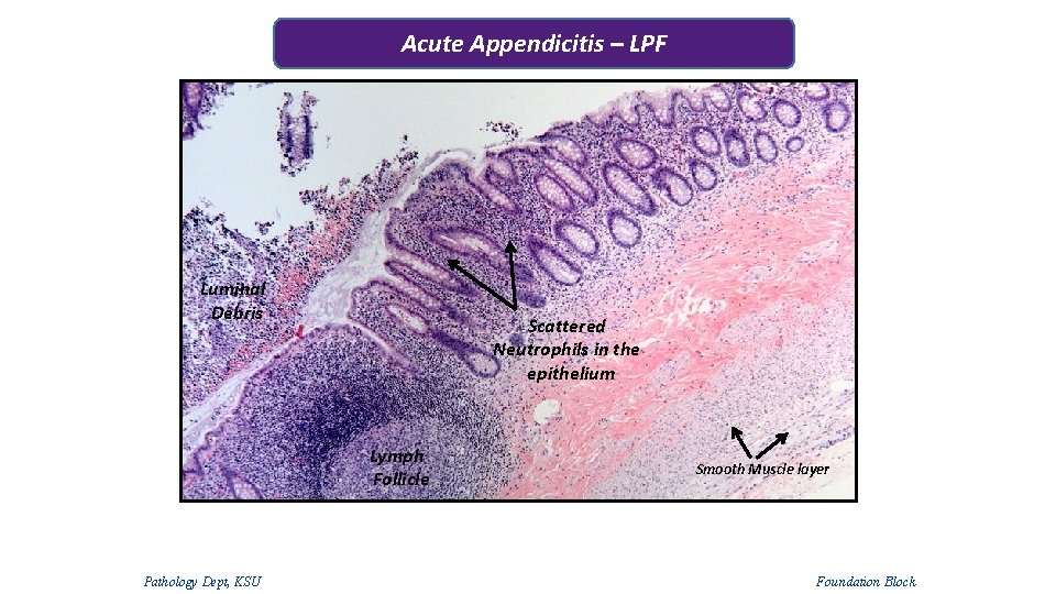 Acute Appendicitis – LPF Luminal Debris Scattered Neutrophils in the epithelium Lymph Follicle Pathology