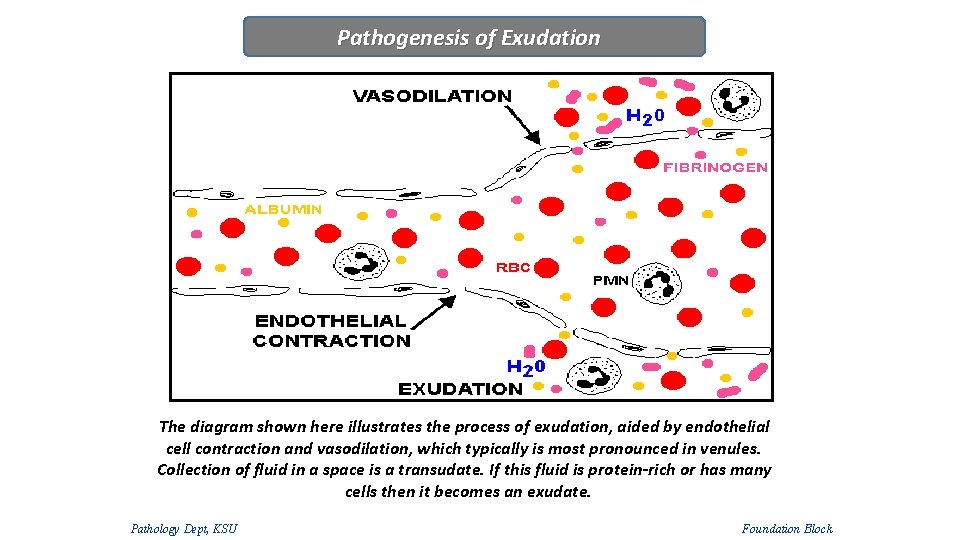 Pathogenesis of Exudation The diagram shown here illustrates the process of exudation, aided by