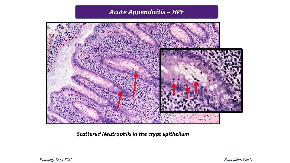 Acute Appendicitis – HPF Scattered Neutrophils in the crypt epithelium Pathology Dept, KSU Foundation