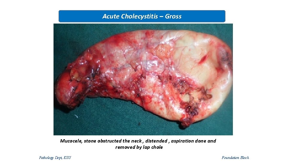 Acute Cholecystitis – Gross Mucocele, stone obstructed the neck , distended , aspiration done