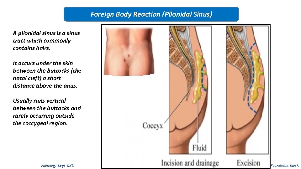 Foreign Body Reaction (Pilonidal Sinus) A pilonidal sinus is a sinus tract which commonly