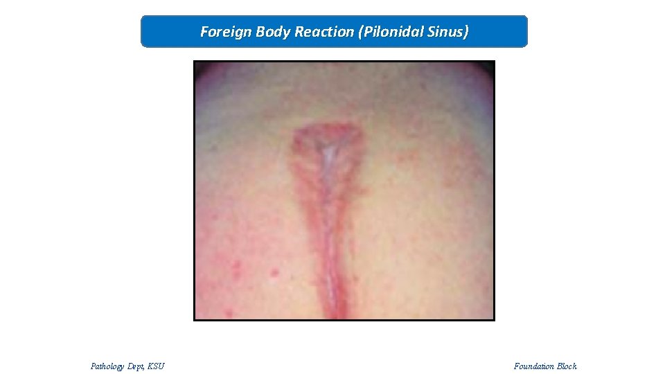 Foreign Body Reaction (Pilonidal Sinus) Pathology Dept, KSU Foundation Block 