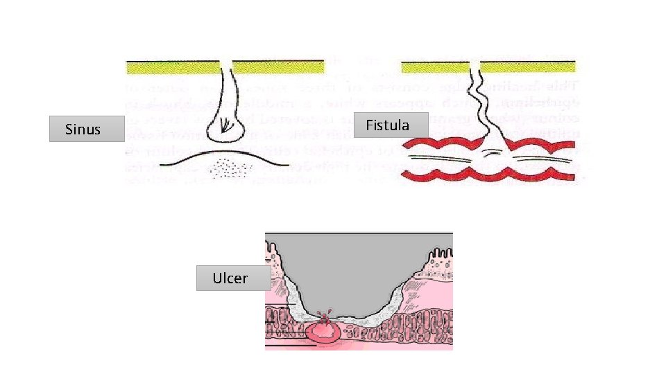 Fistula Sinus Ulcer 