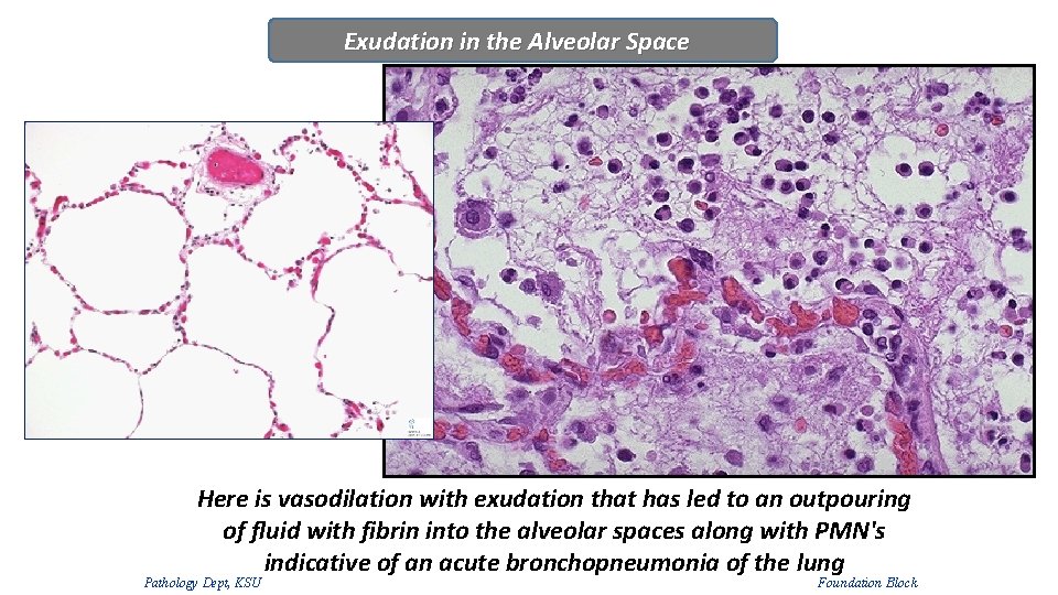 Exudation in the Alveolar Space Here is vasodilation with exudation that has led to