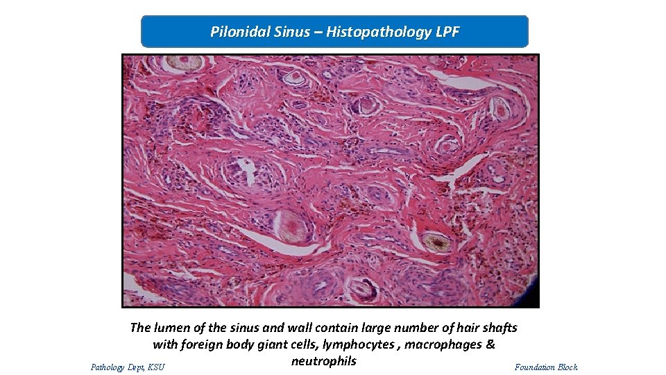 Pilonidal Sinus – Histopathology LPF The lumen of the sinus and wall contain large