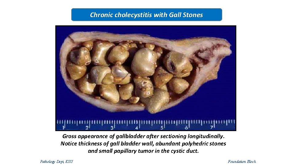 Chronic cholecystitis with Gall Stones Gross appearance of gallbladder after sectioning longitudinally. Notice thickness