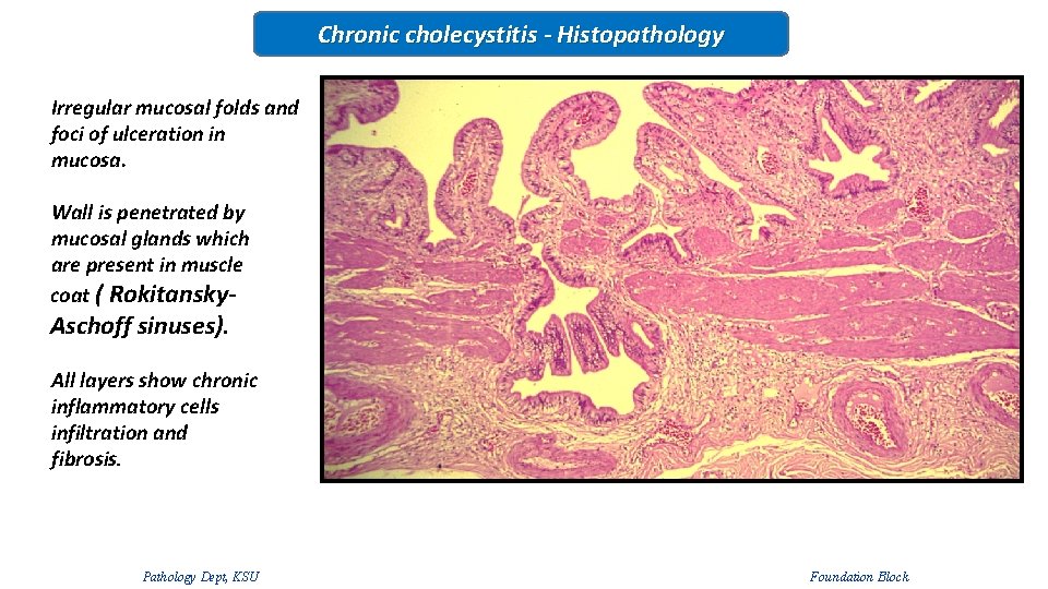 Chronic cholecystitis - Histopathology Irregular mucosal folds and foci of ulceration in mucosa. Wall