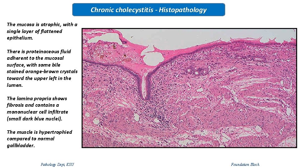 Chronic cholecystitis - Histopathology The mucosa is atrophic, with a single layer of flattened