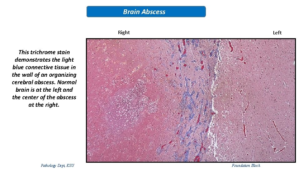 Brain Abscess Right Left This trichrome stain demonstrates the light blue connective tissue in