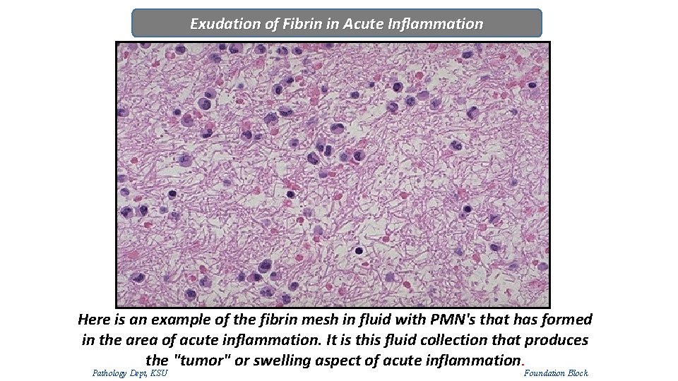 Exudation of Fibrin in Acute Inflammation Here is an example of the fibrin mesh