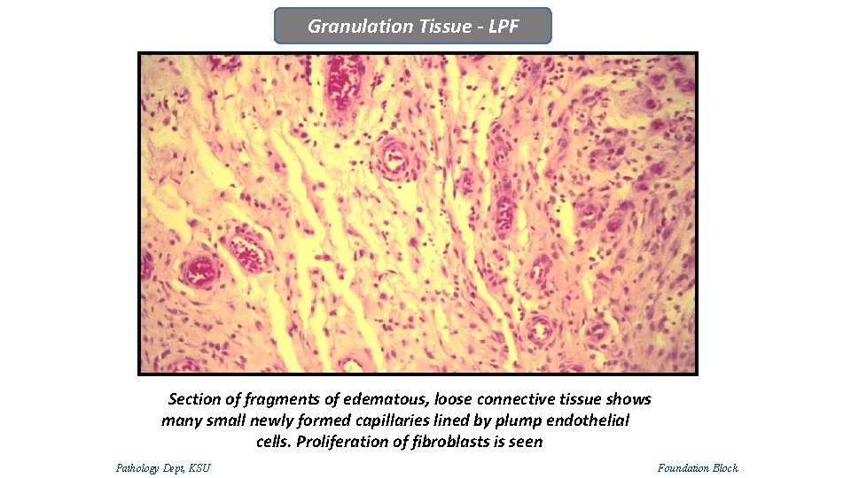 Granulation Tissue - LPF Section of fragments of edematous, loose connective tissue shows many