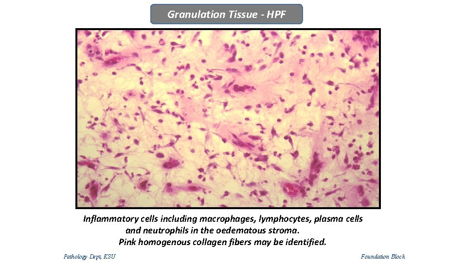 Granulation Tissue - HPF Inflammatory cells including macrophages, lymphocytes, plasma cells and neutrophils in