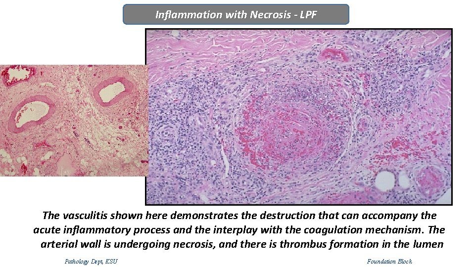 Inflammation with Necrosis - LPF The vasculitis shown here demonstrates the destruction that can