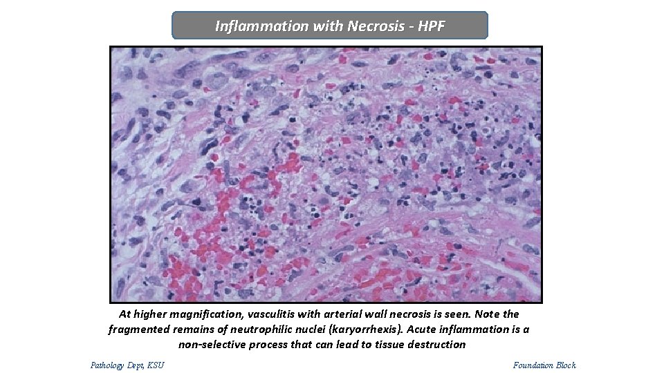 Inflammation with Necrosis - HPF At higher magnification, vasculitis with arterial wall necrosis is