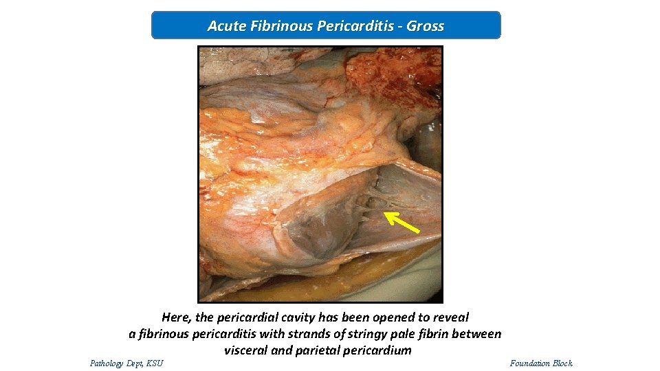 Acute Fibrinous Pericarditis - Gross Here, the pericardial cavity has been opened to reveal