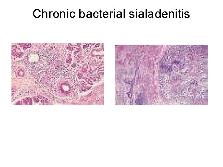 Chronic bacterial sialadenitis 