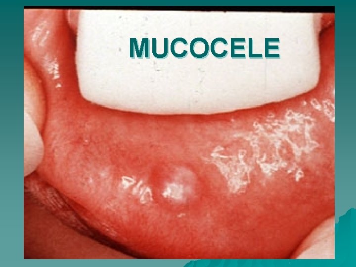 MUCOCELE 