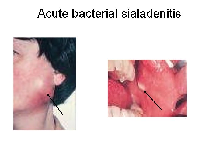 Acute bacterial sialadenitis 
