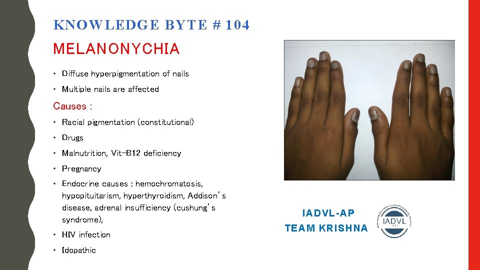 KNOWLEDGE BYTE # 104 MELANONYCHIA • Diffuse hyperpigmentation of nails • Multiple nails are