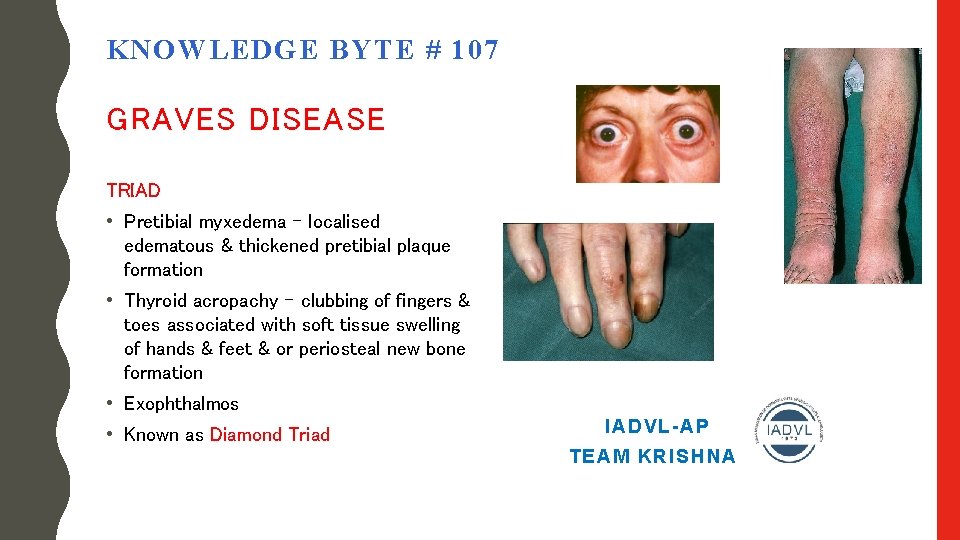 KNOWLEDGE BYTE # 107 GRAVES DISEASE TRIAD • Pretibial myxedema – localised edematous &