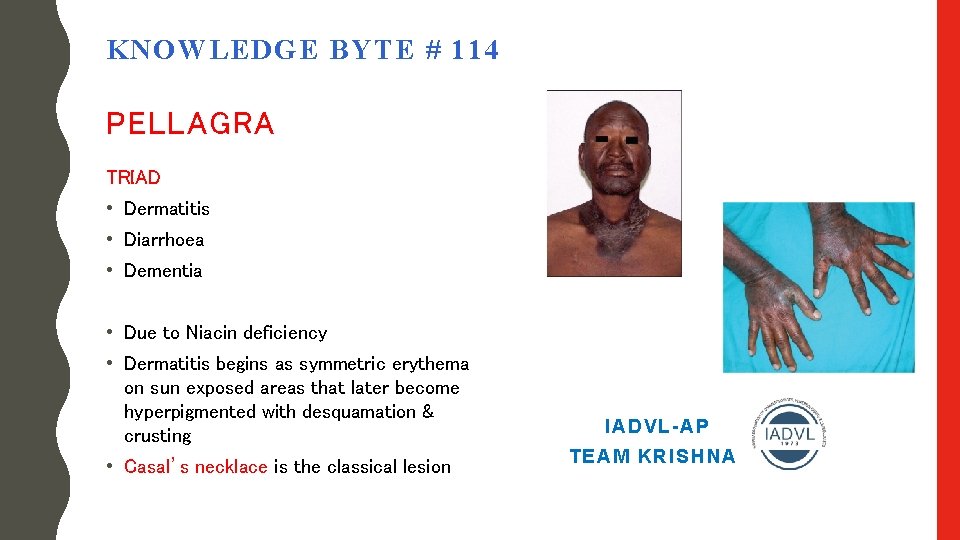 KNOWLEDGE BYTE # 114 PELLAGRA TRIAD • Dermatitis • Diarrhoea • Dementia • Due