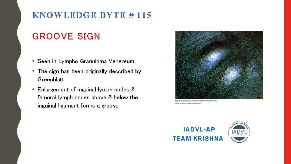 KNOWLEDGE BYTE # 115 GROOVE SIGN • Seen in Lympho Granuloma Venereum • The