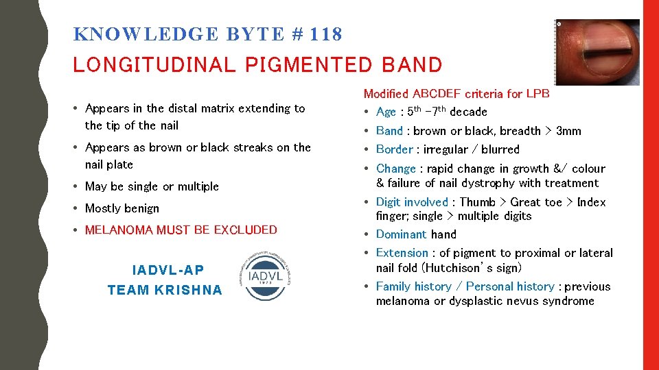 KNOWLEDGE BYTE # 118 LONGITUDINAL PIGMENTED BAND • Appears in the distal matrix extending