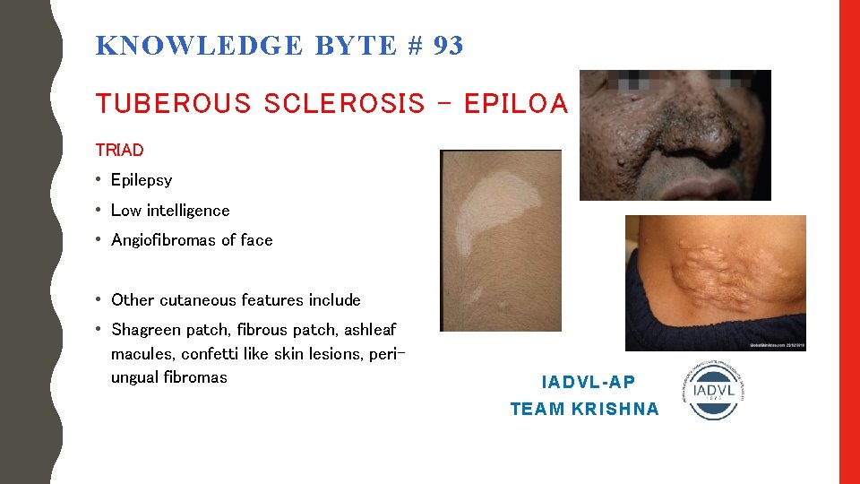 KNOWLEDGE BYTE # 93 TUBEROUS SCLEROSIS - EPILOA TRIAD • Epilepsy • Low intelligence