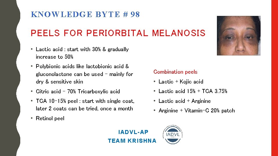 KNOWLEDGE BYTE # 98 PEELS FOR PERIORBITAL MELANOSIS • Lactic acid : start with