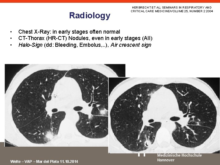 Radiology • • • HERBRECHT ET AL: SEMINARS IN RESPIRATORY AND CRITICAL CARE MEDICINE/VOLUME