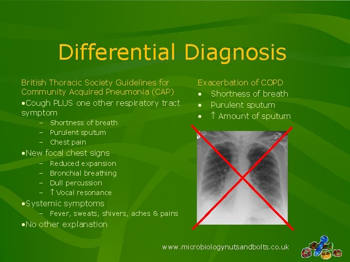 Differential Diagnosis British Thoracic Society Guidelines for Community Acquired Pneumonia (CAP) • Cough PLUS