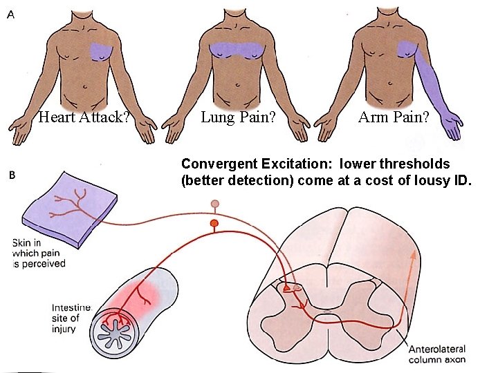 Heart Attack? Lung Pain? Arm Pain? Convergent Excitation: lower thresholds (better detection) come at