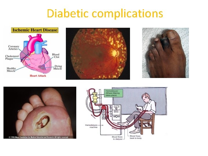 Diabetic complications 