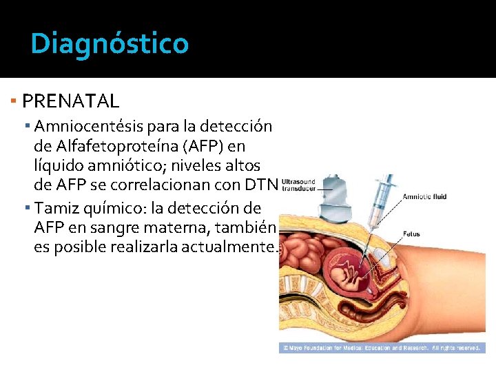 Diagnóstico ▪ PRENATAL ▪ Amniocentésis para la detección de Alfafetoproteína (AFP) en líquido amniótico;