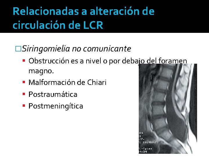 Relacionadas a alteración de circulación de LCR �Siringomielia no comunicante Obstrucción es a nivel