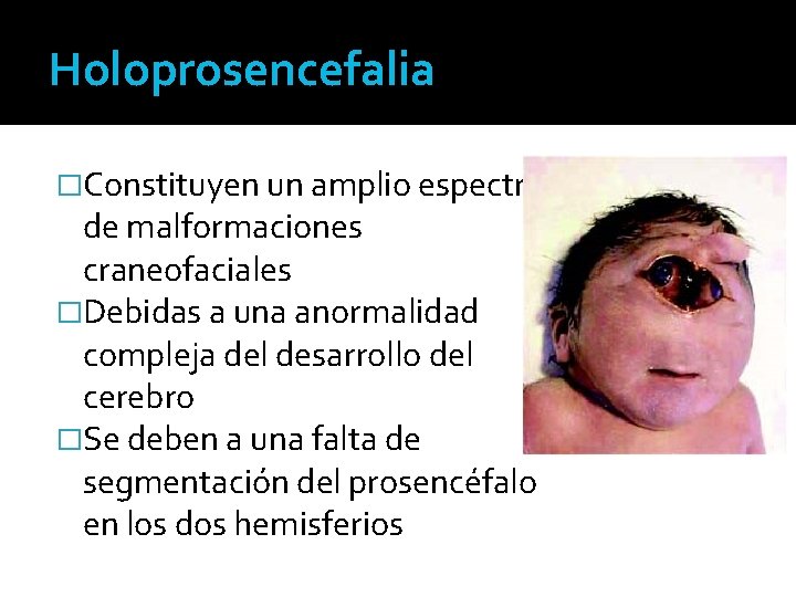 Holoprosencefalia �Constituyen un amplio espectro de malformaciones craneofaciales �Debidas a una anormalidad compleja del