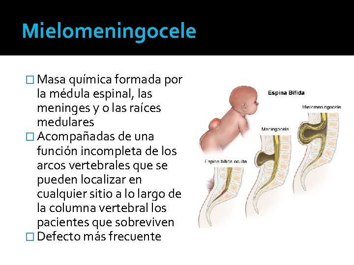 Mielomeningocele � Masa química formada por la médula espinal, las meninges y o las