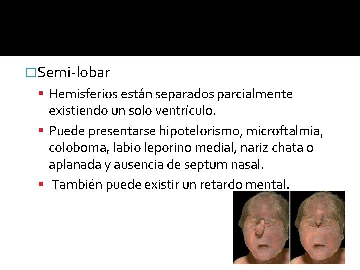 �Semi-lobar Hemisferios están separados parcialmente existiendo un solo ventrículo. Puede presentarse hipotelorismo, microftalmia, coloboma,