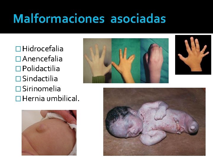 Malformaciones asociadas � Hidrocefalia � Anencefalia � Polidactilia � Sindactilia � Sirinomelia � Hernia