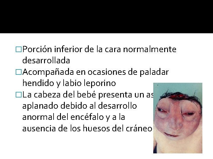 �Porción inferior de la cara normalmente desarrollada �Acompañada en ocasiones de paladar hendido y